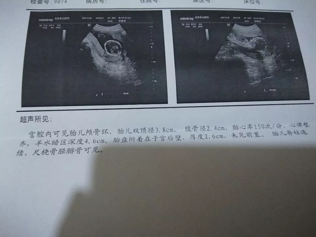 3、怀女宝的症状可准了:宝妈们，知道什么是怀女宝的准确特征吗？