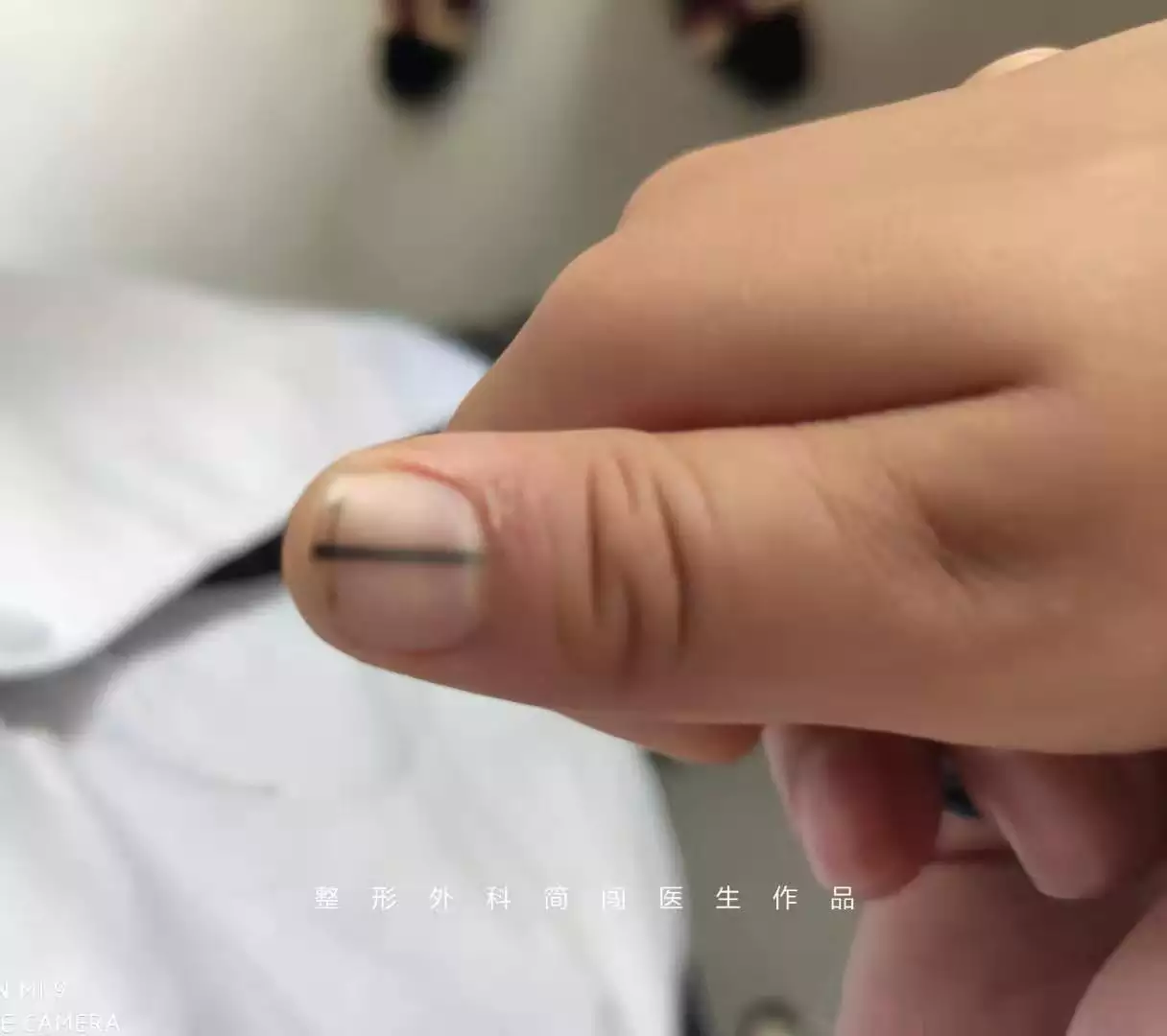 3、右手突然長痣是緣分要出現嗎:女生右手無名指長痣