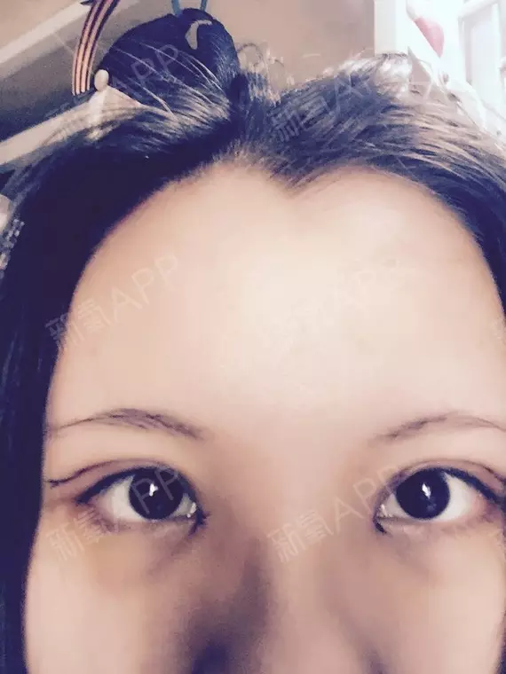 2、开眼角影响运势吗:做双眼皮手术和开眼角会不会影响命格