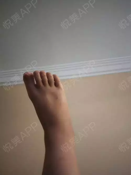 3、堅持熱敷我的筋膜炎竟然好了:足底筋膜炎是靜養好還是鍛煉好可我天天鍛煉走路現