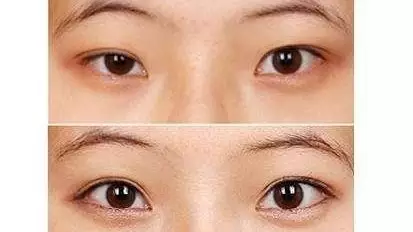 眼睛八字痕怎么消除：为什么会出现眼睛下面有八字纹