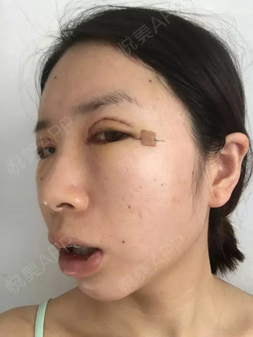 2、人中缝针后有疤运势:上嘴唇人中处打球撞伤缝针五天了，缝了四针，缝线处长了，正常吗
