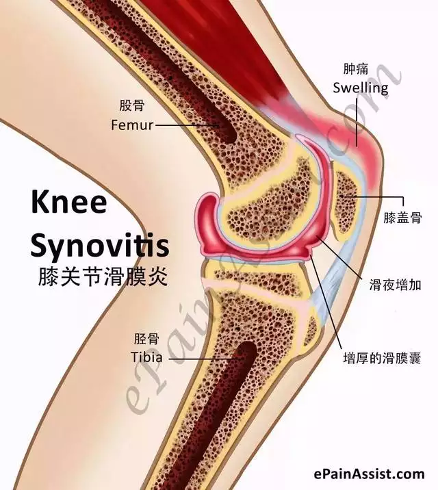 3、15天逼走滑滑膜炎的方法:輕度滑膜炎的根治辦法