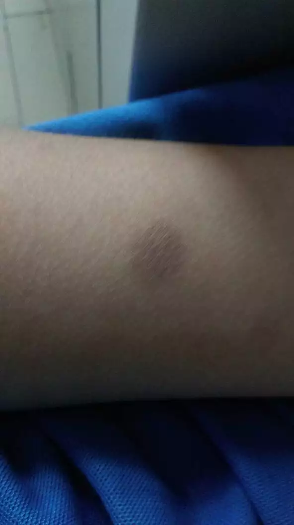 4、PPD測試后出現一個紅腫的包正常么？（好害怕啊！！！有紅包）