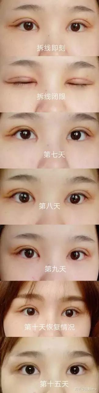 2、割双眼皮能改变运势吗:割双眼皮会改变一个人的运势吗
