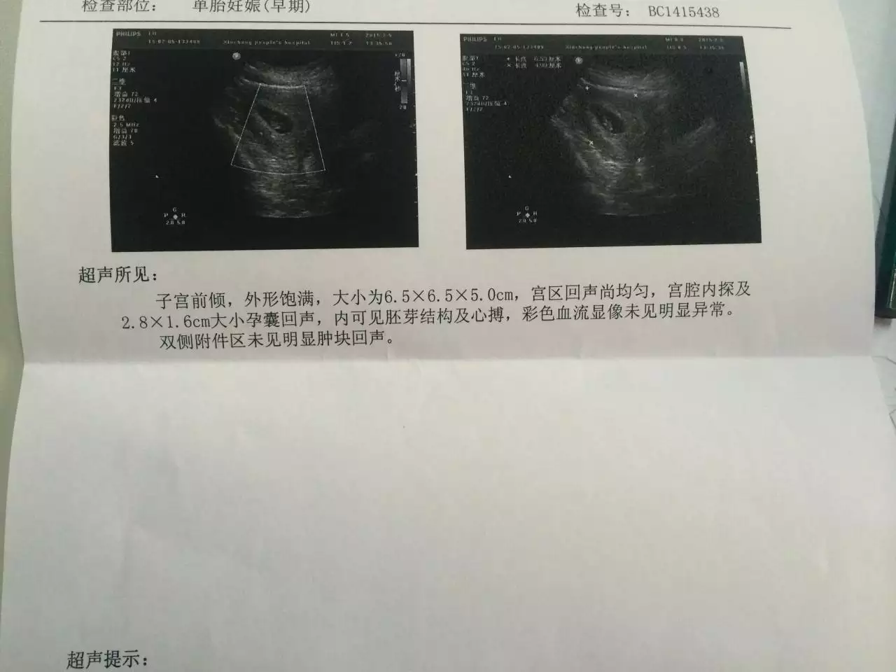 2、其实看孕囊很准:生男生女看孕囊准吗