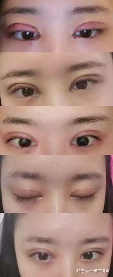 1、做双眼皮影响运势:做双眼皮，会不会把好运气变坏了