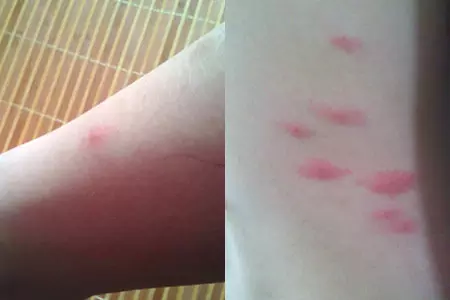 2、蟎蟲咬過後的疙瘩照片:蟎蟲咬后怎麼讓疙瘩快速褪下