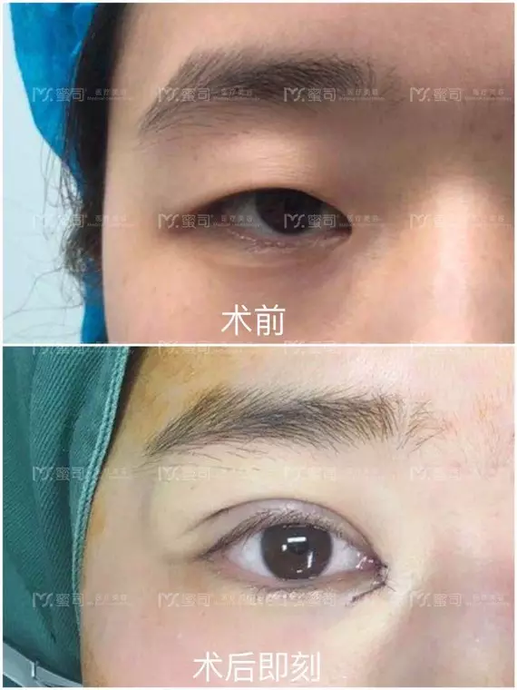 1、开眼角影响运势吗:为什么割双眼皮开眼角会影响老公运气呢？