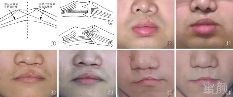 3、人中缝针后有疤运势:分析：脸上有疤对人生运势有什么影响