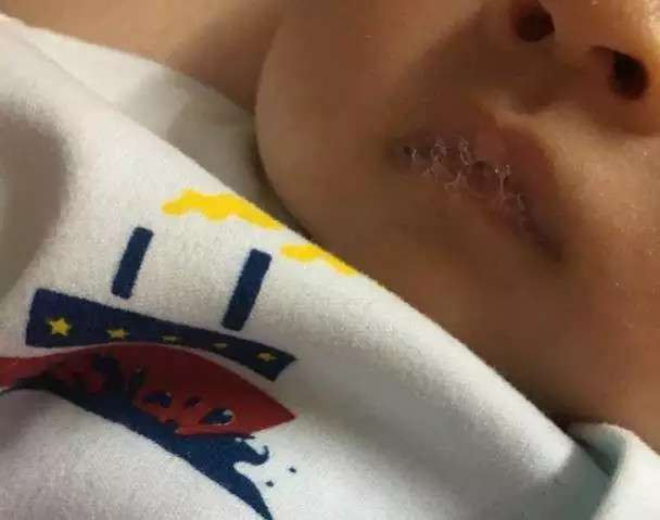 2、肺炎吐泡泡與口水泡泡圖片:為什麼寶寶吐泡泡