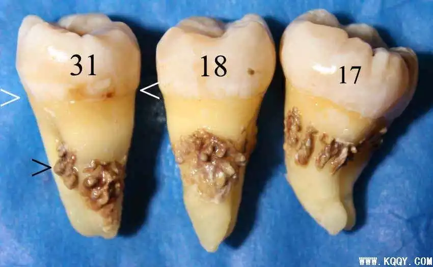 1、洗牙对运势有帮助吗:洗牙有什么好处和坏处