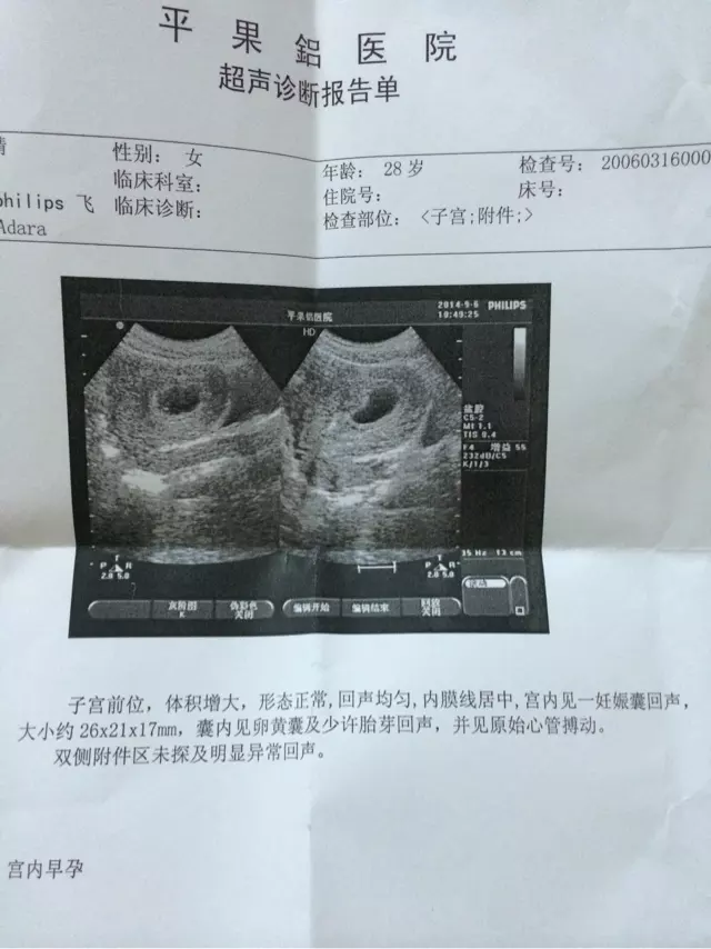 3、其实看孕囊很准:听说看孕囊形状可以大概猜出男女性别，准不准呢，帮我看下