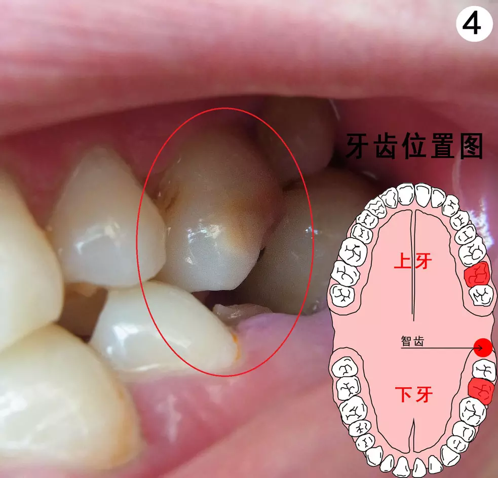 2、长智齿代表什么运势:人长智齿的概率是多少？