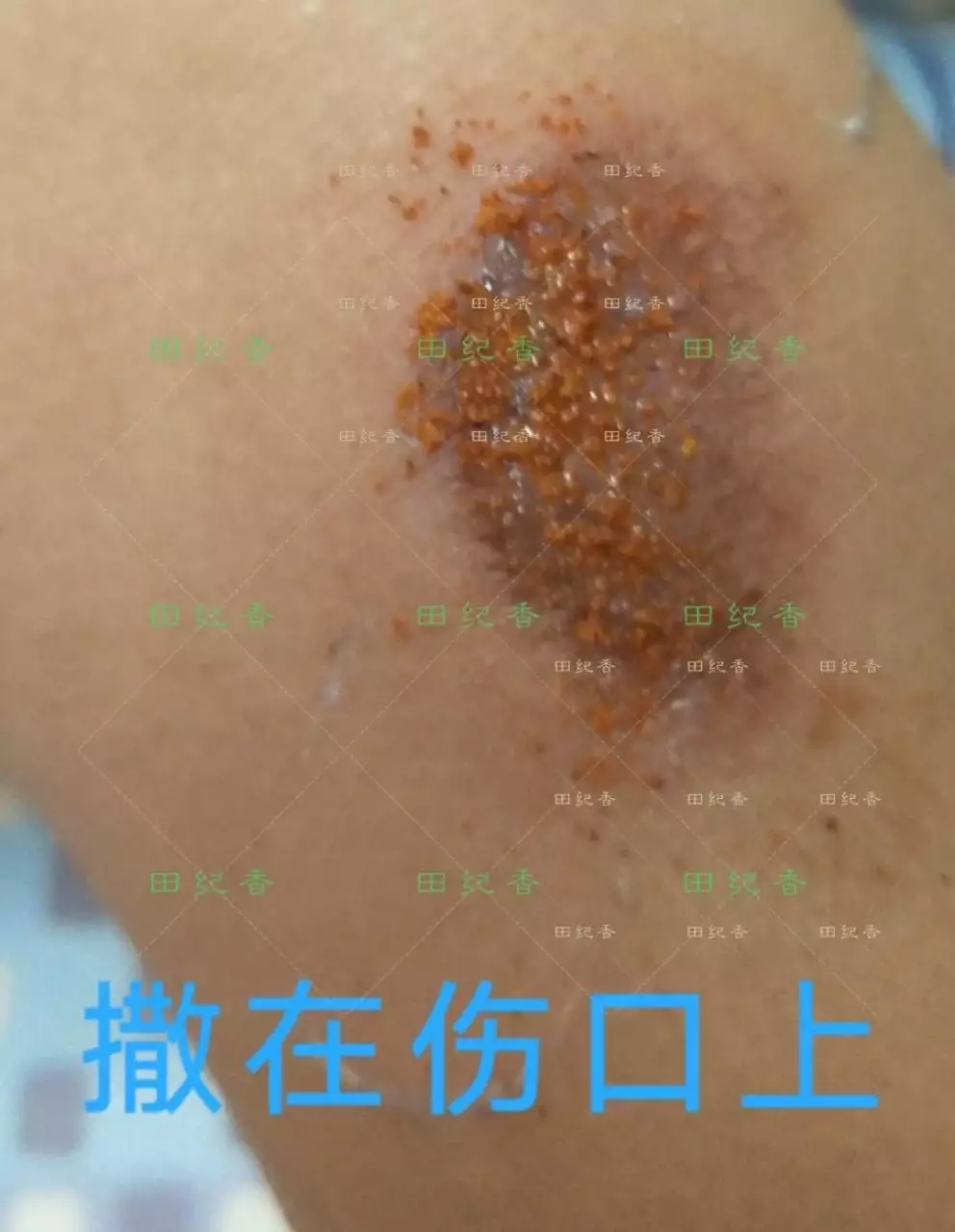 2、膿痂和正常痂的區別圖片:膿包瘡正常結痂是什麼顏色的?