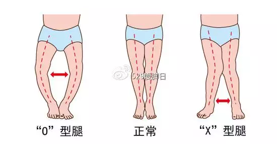 1岁宝宝走路内八字