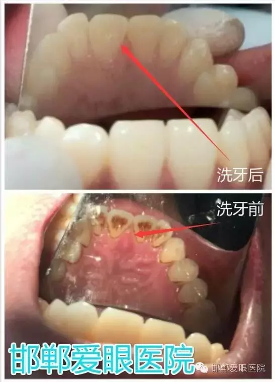 4、洗牙对运势有帮助吗:洗牙会不会对身体有什么害处?