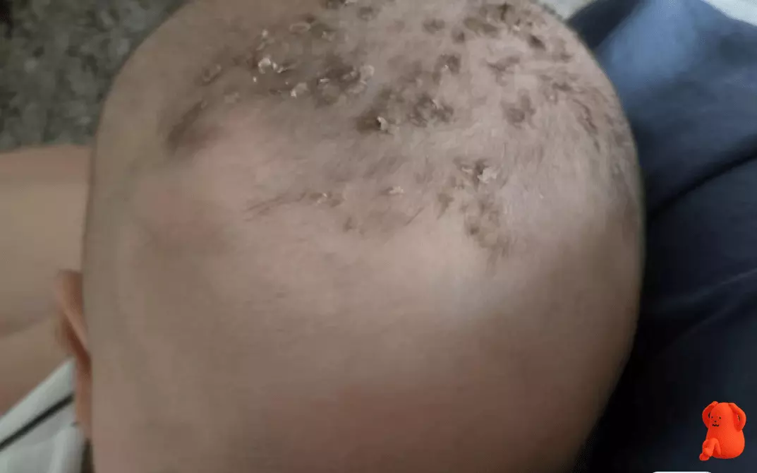 4、膿痂和正常痂的區別圖片:傷口結痂后裏面有濃水