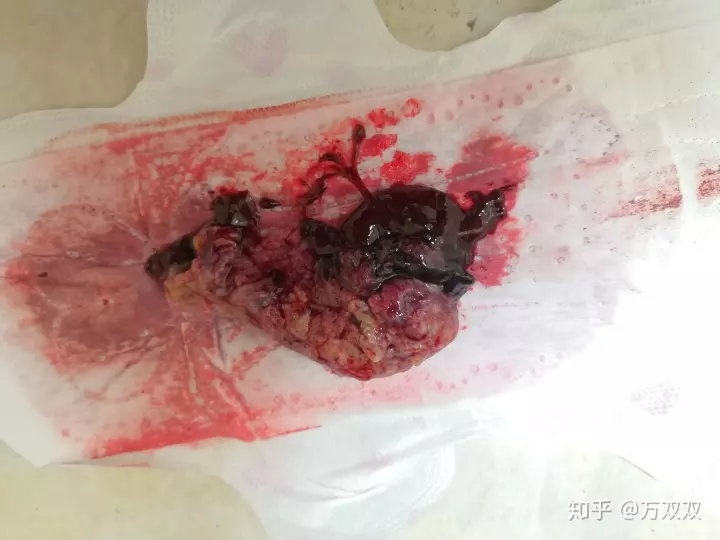 2、葯流10個人有9個流不幹凈:為什麼有些人葯流幾天就乾淨了，而我都十幾天了還有流呢