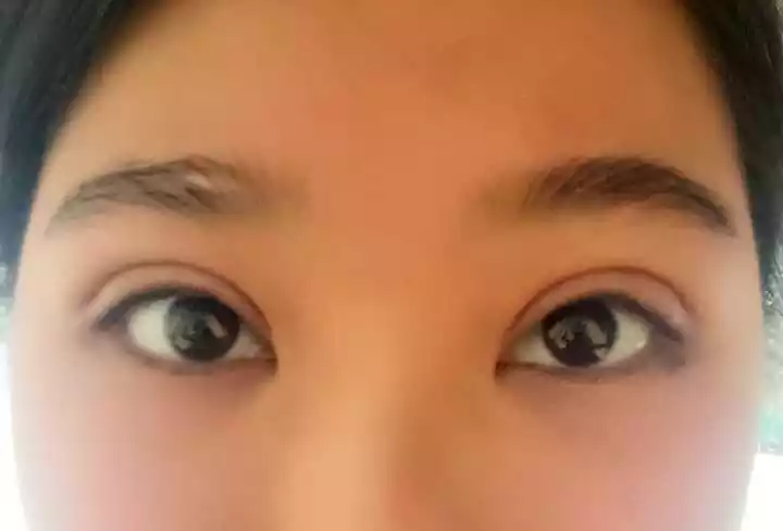 3、割双眼皮能改变运势吗:双眼皮会改变运气吗