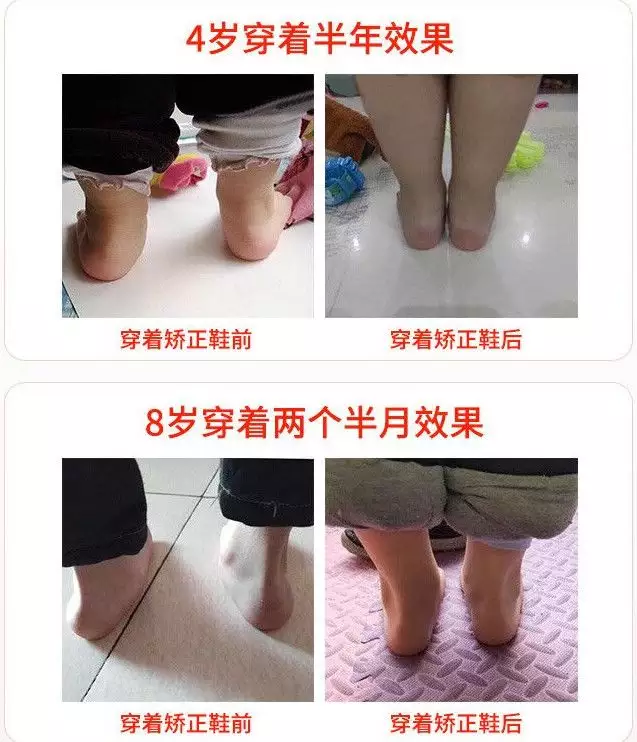 20个月宝宝走路内八字怎么办：宝宝一岁八个月了，走路有点内八，我要怎么帮她改善