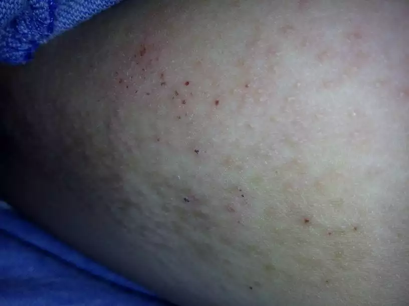 3、蟎蟲咬過後的疙瘩照片:被蟎蟲咬了之後會疙瘩嗎？