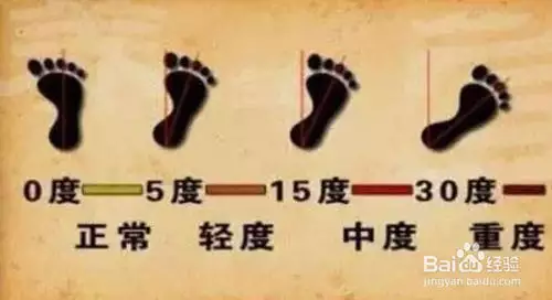 成年外八字脚怎么矫正：跑步外八字