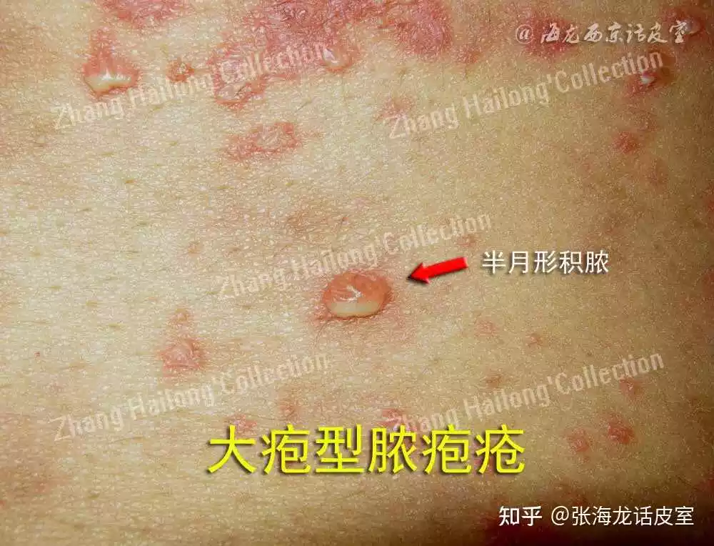 3、化膿后的傷口膿液排除后，正常換藥，多少天能結痂？多少天能掉痂？