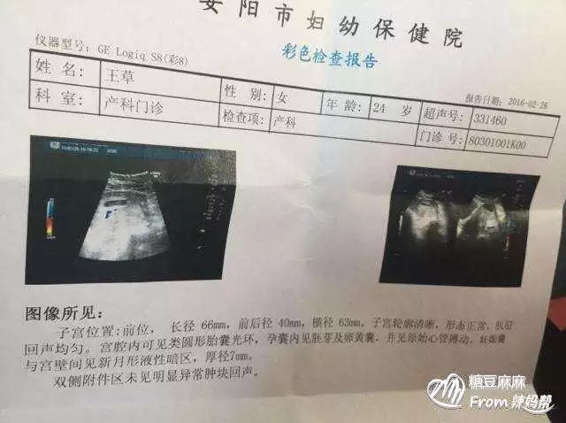 4、孕囊形狀看男女(超准):孕囊大小看男女，准嗎？