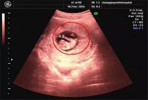 3、生了男孩當時42天孕囊:懷孕42天，孕囊為1.2cm0.8cm,是男孩還是女孩？