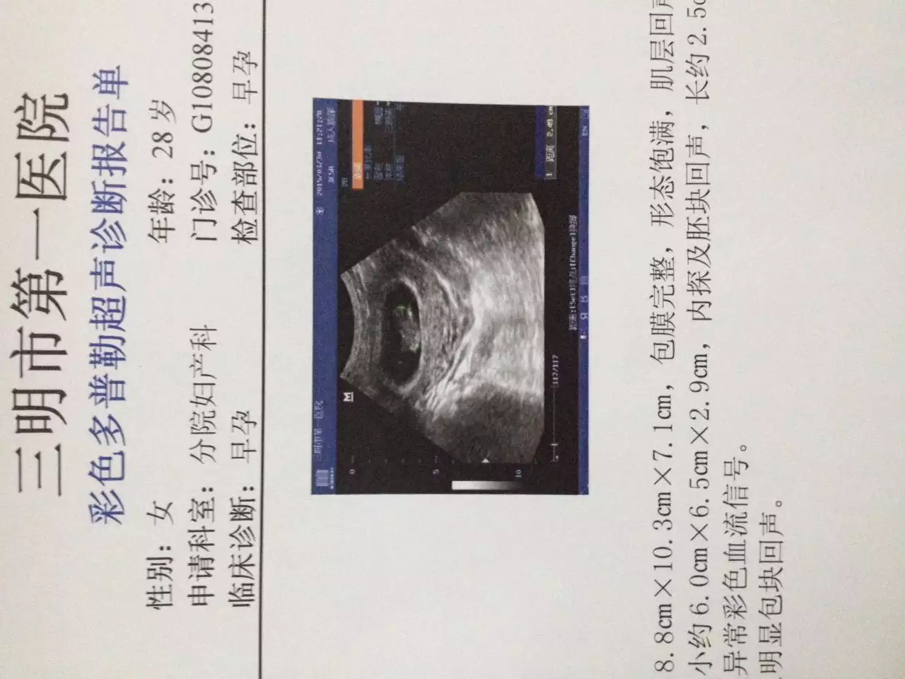 5、其实看孕囊很准:从孕囊看男女真的那么准吗？