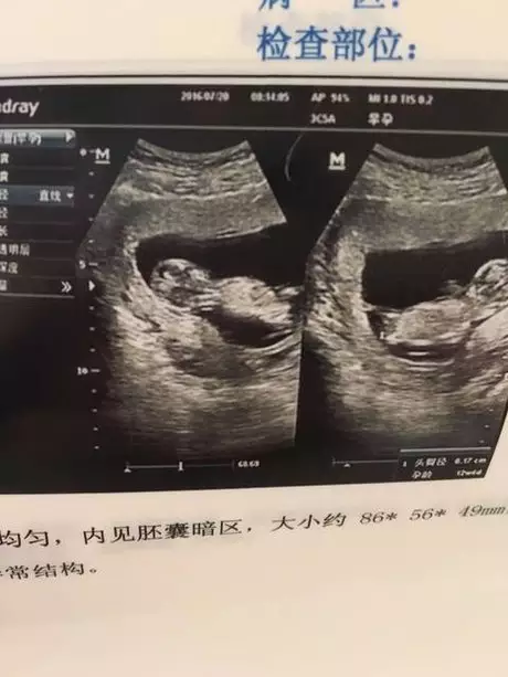 4、孕12周胎兒小雞彩超圖:懷男孩4個月b超單圖片是什麼樣子呢？