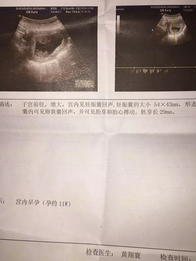 2、孕囊中間数字小是兒子:B超單數據的秘密——告訴你懷的是男孩還是女孩