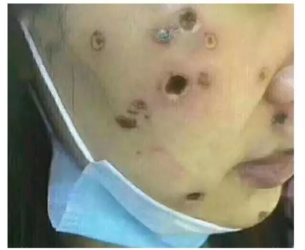 3、點痣后運氣變了:點痣能改變人的命運嗎？？