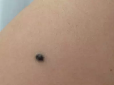 2、胳膊有痣是天人:左手胳膊有痣代表什麼