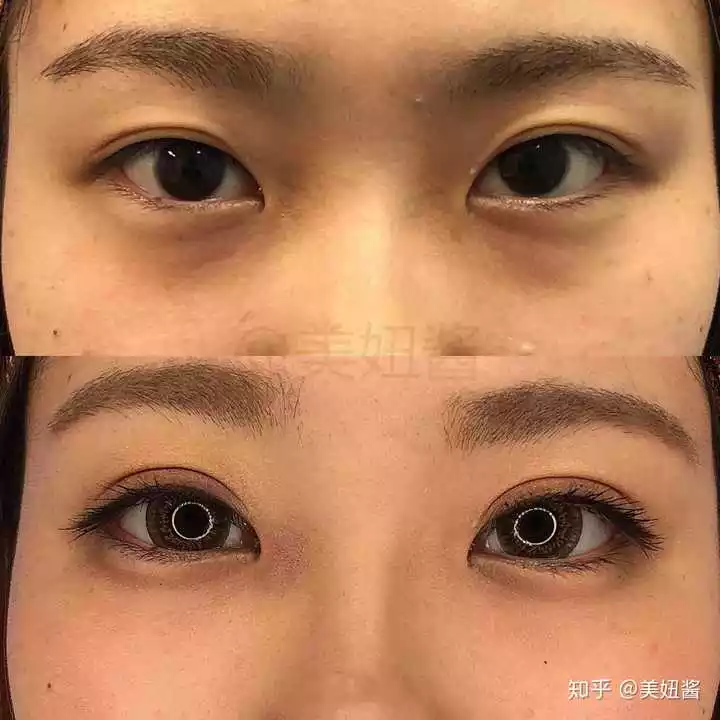 1、割双眼皮能改变运势吗:割双眼皮会不会影响运气