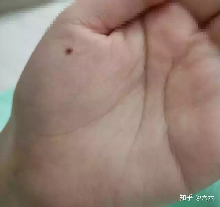 4、女人身上**的16胎記:一個男人如果真的喜歡一個個女生，會在意她身上有很多胎記嗎？