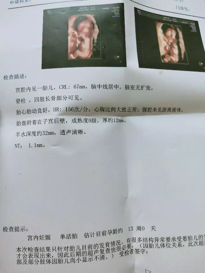 3、NT單子男孩有圈圈:11周NT怎麼看男孩女孩？