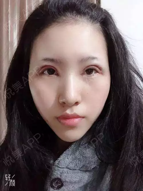6、开眼角影响运势吗:开眼角对人好不好