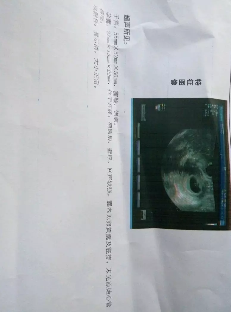 6、其实看孕囊很准:孕囊看男女准确率有多少