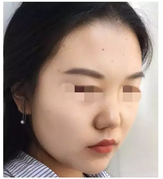 3、点痣会影响运势吗:点痣的话，有没有忌讳是什么不能点掉的，说会影响运势什么的