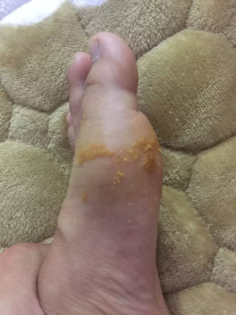 4、堅持熱敷我的筋膜炎竟然好了:筋膜炎怎樣才能治癒