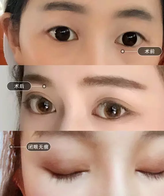 2、做双眼皮影响运势:做双眼皮会影响风水家运吗?
