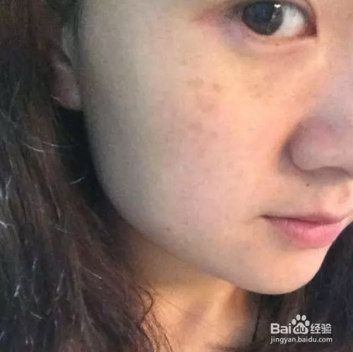 1、女人臉上長斑是怎麼回事:38歲女人臉上開始長斑怎麼辦