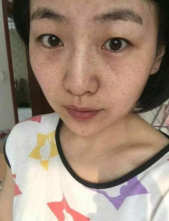 2、女人的臉為什麼會長斑:女人臉上為什麼會長斑？