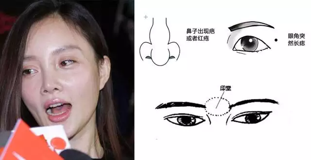 1、人中缝针后有疤运势:眉骨上方缝针了会影响运势吗?