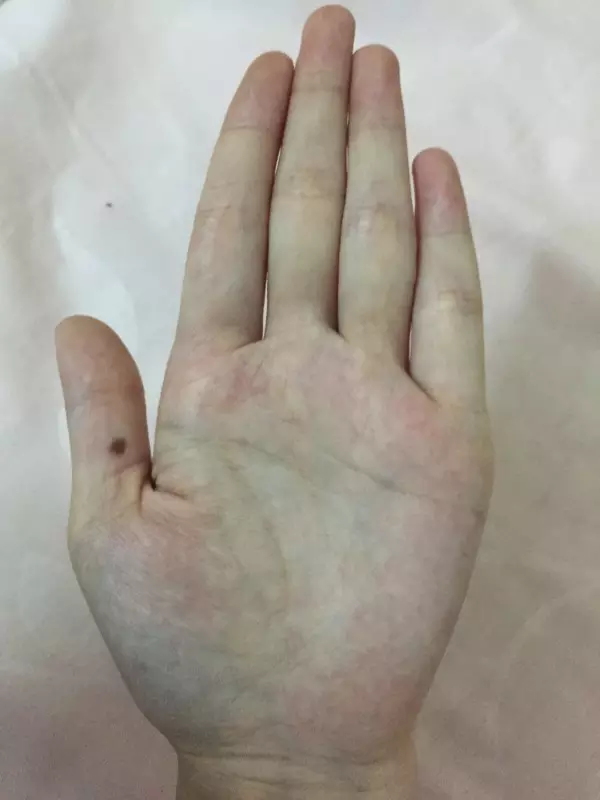 2、聽說左手有痣的人都是被愛:男生左手有痣好不好