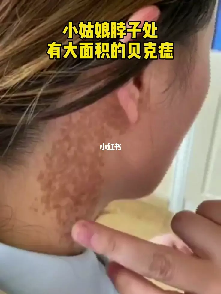 2、我該怎麼辦，我20歲女孩，我身上可見部位有胎記，我以前都沒有很介意胎記的，不過現在實習結束找工作