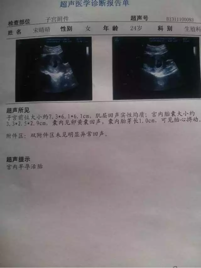懷孕四個月b超男女圖：懷男孩4個月b超單圖片是什麼樣子呢？