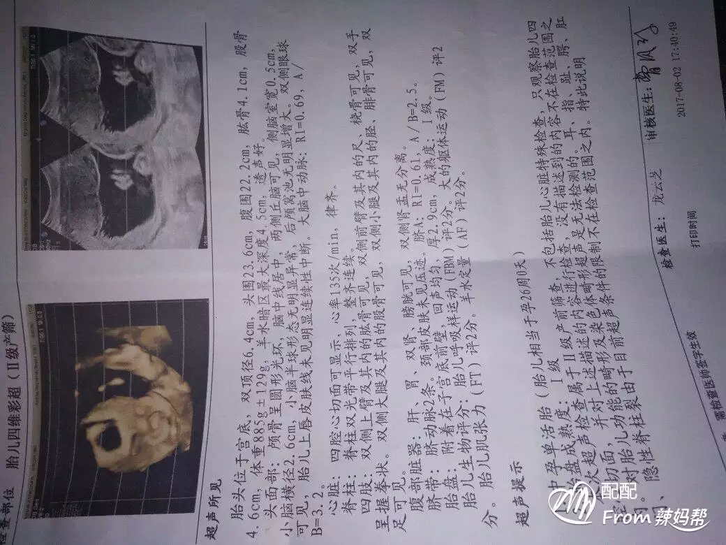 四維彩超右上角的MI是什麼意思：TIB和MI分別是啥意思